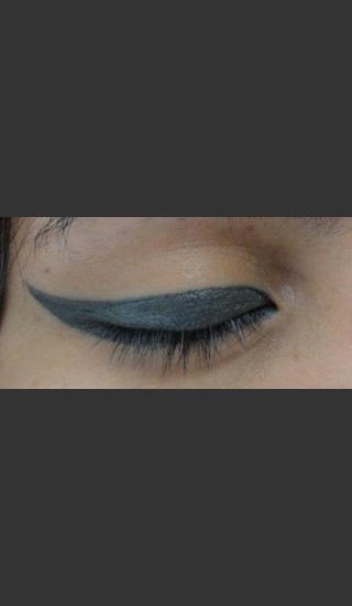 Before Photo for Treatment of Permanent Eye Liner - Roy G. Geronemus, M.D. - Prejuvenation