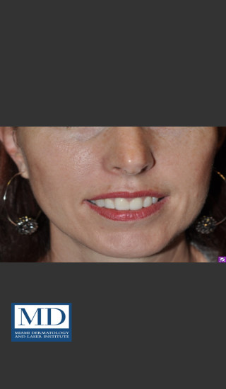 After Photo for Neurotoxin Gummy Smile 128 - Jill S. Waibel, MD - Prejuvenation