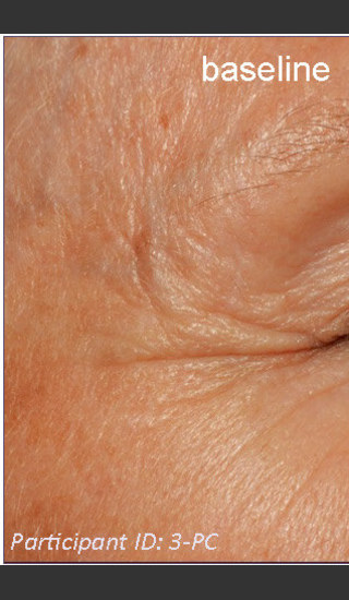 Before Photo for DefenAge Clinical Power Trio -  - Prejuvenation