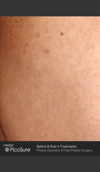 After Photo for Tattoo Removal of Skull -  - Prejuvenation