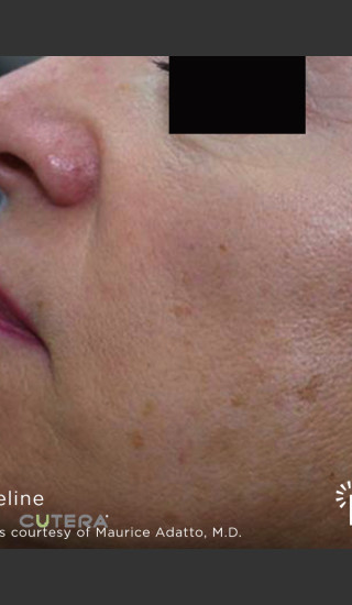 Before Photo for Sun Damage Before & After Photo -  - Prejuvenation