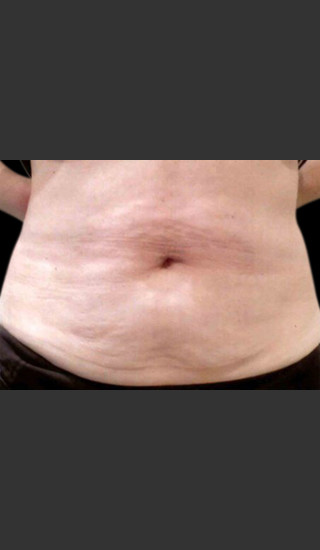 Before Photo for Body Contouring Treatment #114 -  - Prejuvenation
