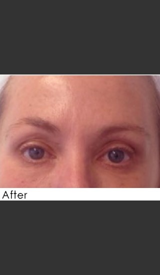 After Photo for Undereye Filler + Exilis Elite Radiofrequency - Annie Chiu, MD - Prejuvenation