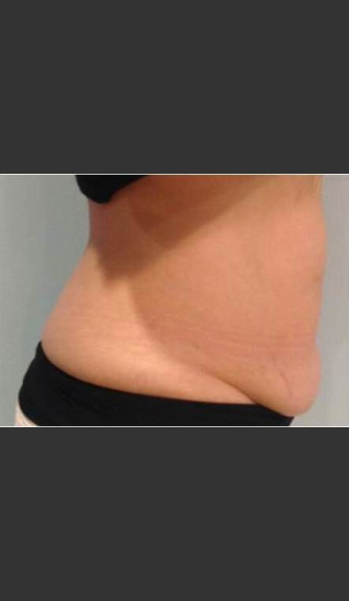 Before Photo for BodyFX #1 -  - Prejuvenation