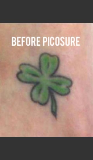Before Photo for Treatment of Tattoo with Picosure - Roy G. Geronemus, M.D. - Prejuvenation