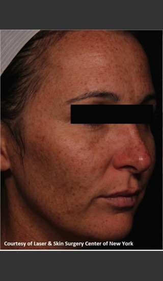 Before Photo for Full face Treament with Fraxel - Roy G. Geronemus, M.D. - Prejuvenation