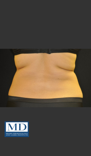 Before Photo for  Body Contouring Treatment 141 - Jill S. Waibel, MD - Prejuvenation