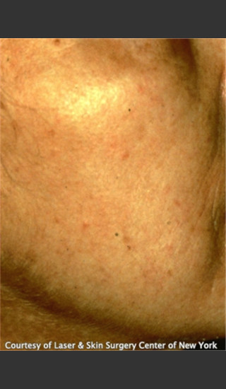 After Photo for Treatment of Facial Redness -  - Prejuvenation