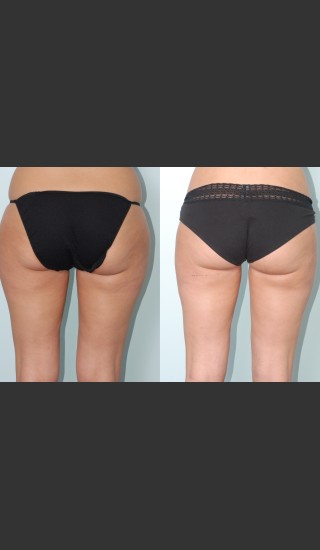 Before Photo for Liposuction of waist, hips, thighs, and tummy. - Mark B. Taylor, M.D. - Prejuvenation