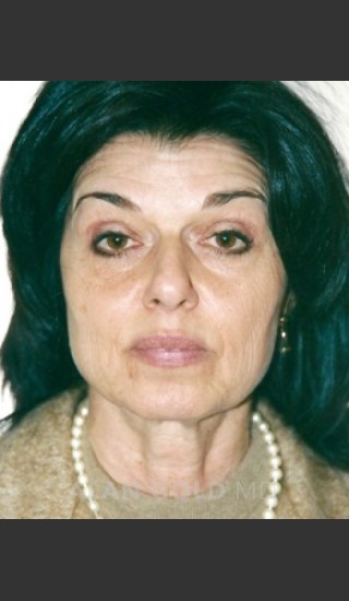 Before Photo for Rhytidectomy (Facelift) 1884 - Alan Gold MD - Prejuvenation