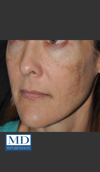 Before Photo for Melasma Face Treatment 118 - Jill S. Waibel, MD - Prejuvenation