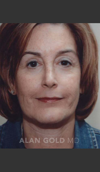After Photo for Rhytidectomy (Facelift) 120 - Alan Gold MD - Prejuvenation