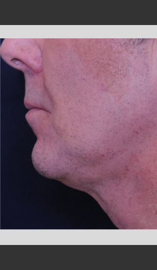 After Photo for Profound Contour Treatment of Neck -  - Prejuvenation