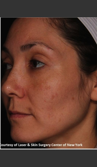 After Photo for Treatment of Melasma -  - Prejuvenation