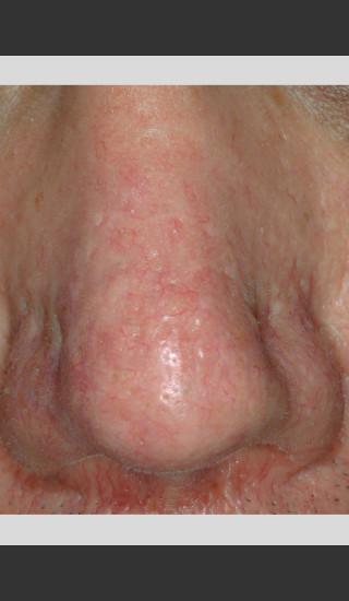 After Photo for Gentle Laser Vascular Lesions of the Nose -  - Prejuvenation
