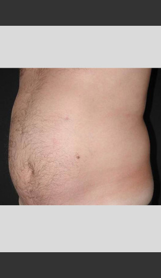 Before Photo for UltraShape Body Contouring Abdomen -  - Prejuvenation