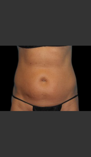 Before Photo for Body Contouring Treatment #123 -  - Prejuvenation
