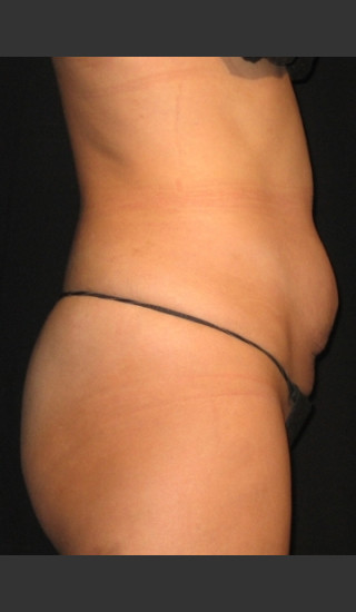 Before Photo for QuantaShape #80 -  - Prejuvenation