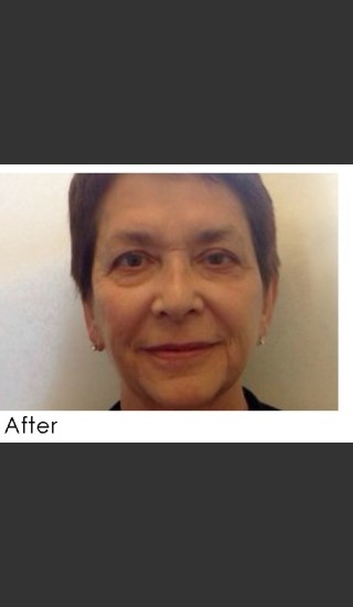 After Photo for Radiesse and Restylane Filler Treatment - Annie Chiu, MD - Prejuvenation