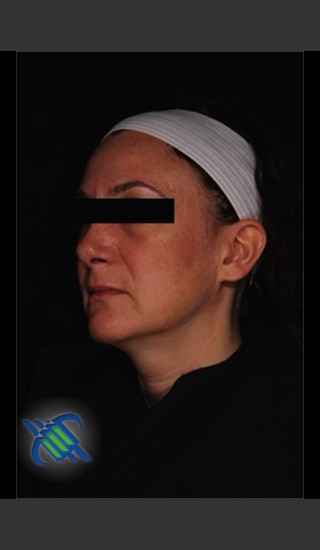 After Photo for Treatment of Facial Melasma - Roy G. Geronemus, M.D. - Prejuvenation