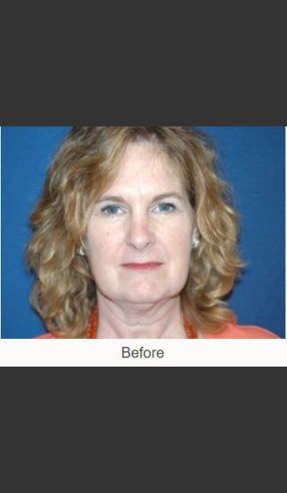 Before Photo for Facelift - Case #23 Details - James N. Romanelli, MD, FACS - Prejuvenation