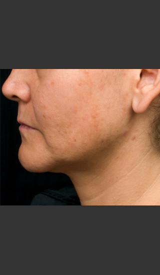 After Photo for Thermage Procedure Before and After I -  - Prejuvenation