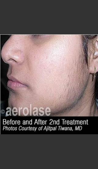 Before Photo for Hair Removal #310 -  - Prejuvenation