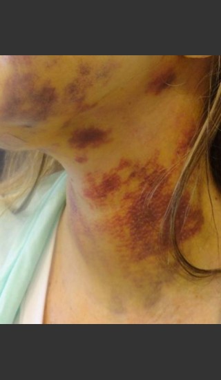 Before Photo for Treatment of Neck Brusing - Roy G. Geronemus, M.D. - Prejuvenation