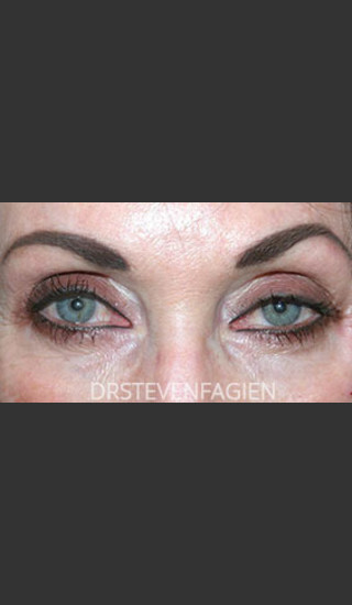 Before Photo for Periorbital Rejuvenation - Patient 3 - Steven Fagien, MD - Prejuvenation