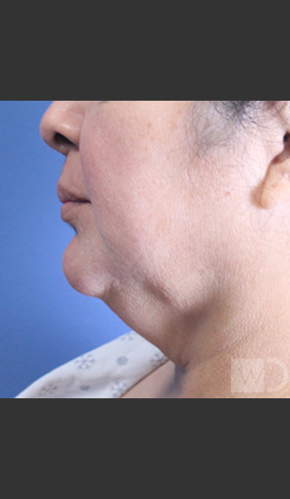Before Photo for SmartLipo Liposuction of Lower Face - Daniel Friedmann  - Prejuvenation
