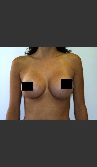 After Photo for Breast Augmentation - Braden C. Stridde, M.D. - Prejuvenation