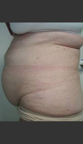 Before Photo for Vanquish NonInvasive Body Shaping - James Newman - Prejuvenation