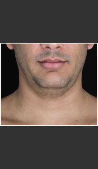 Before Photo for Double Chin Removed 1 CoolSculpting Treatment  - Leyda Elizabeth Bowes, M.D. - Prejuvenation