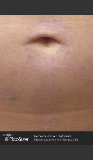 After Photo for Tattoo Removal Before & After Photo of Cross -  - Prejuvenation