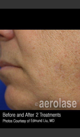 After Photo for Treatment of Facial Pigmentation #328 -  - Prejuvenation