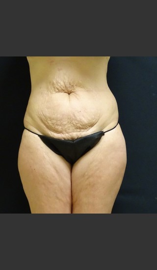 Before Photo for Tummy Tuck Case #1 - Gallaher Plastic Surgery & Spa MD - Prejuvenation
