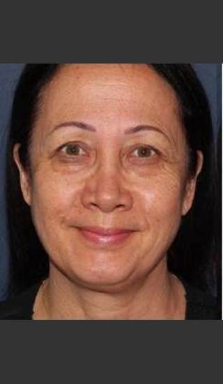 Before Photo for Crow`s Feet Reduction - Kimberly J. Butterwick M.D. - Prejuvenation