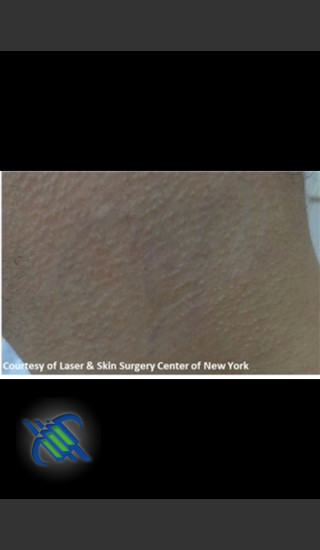 After Photo for Treatment of Lower Back Tattoo - Roy G. Geronemus, M.D. - Prejuvenation