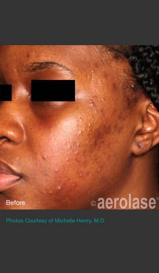 Before Photo for NeoClear by Aerolase Acne Treatment -  - Prejuvenation