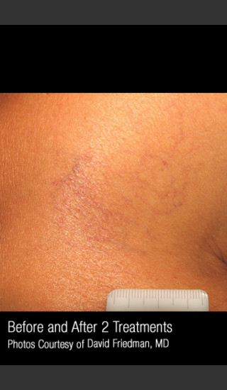 After Photo for Treatment of Leg Veins #315 -  - Prejuvenation