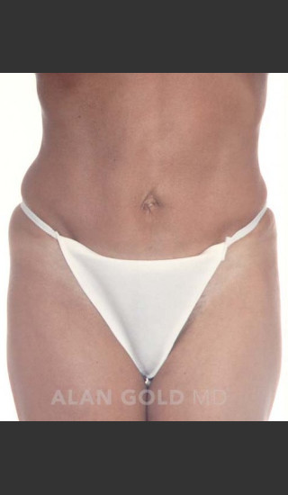 After Photo for Abdominoplasty 279 - Alan Gold MD - Prejuvenation