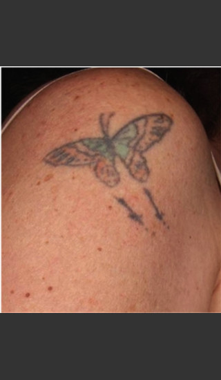 Before Photo for Treatment of Shoulder Tattoo - Roy G. Geronemus, M.D. - Prejuvenation