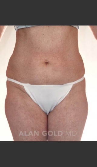 Before Photo for Liposuction 380 - Alan Gold MD - Prejuvenation