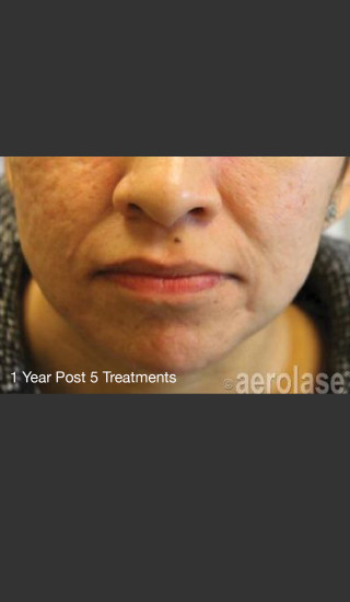 After Photo for NeoClear by Aerolase Acne Treatment - Michael H Gold - Prejuvenation