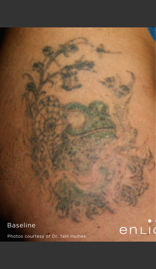 Before Photo for Large Green Tattoo Removel Before & After Photo -  - Prejuvenation