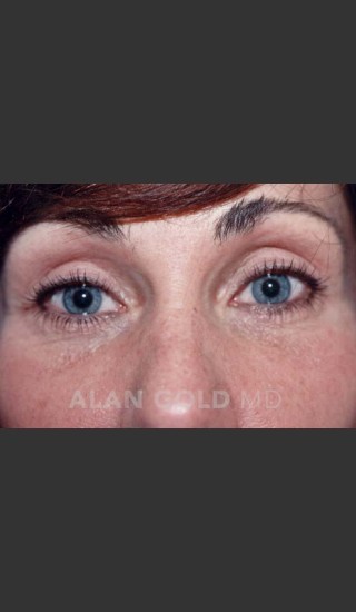 After Photo for Blepharoplasty 1014 - Alan Gold MD - Prejuvenation