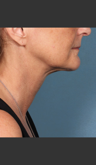 After Photo for Kybella Treatment 55 Year Old Female -  - Prejuvenation