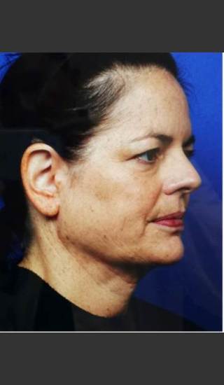 After Photo for Infini Rhytides Treatment -  - Prejuvenation