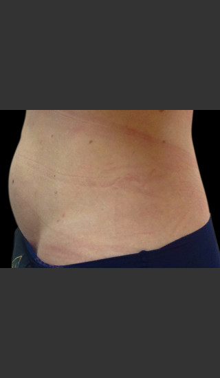 After Photo for Body Contouring Treatment #117 -  - Prejuvenation