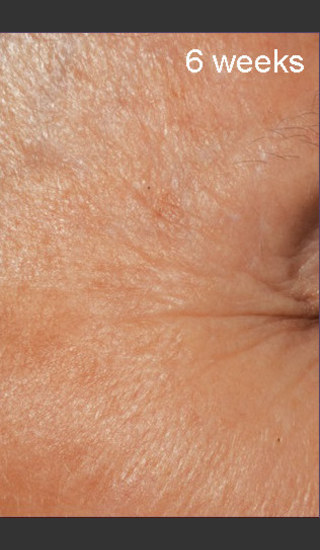 After Photo for DefenAge Clinical Power Trio -  - Prejuvenation